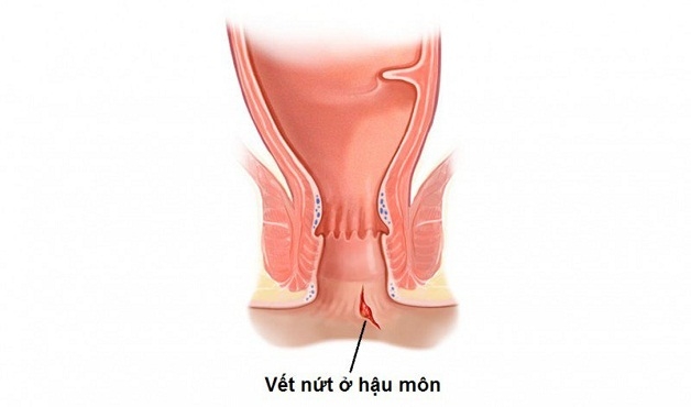Nứt kẽ hậu môn ở phụ nữ sau sinh là nỗi 