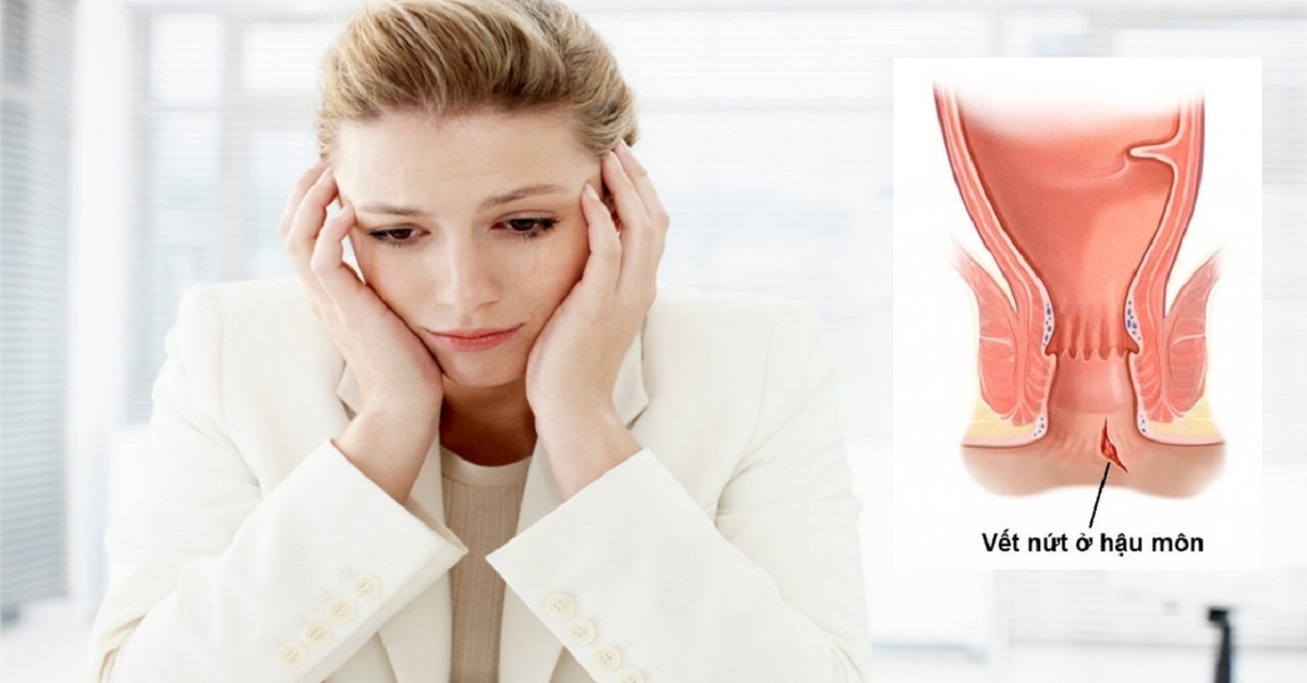 [Giải đáp] Nứt kẽ hậu môn ở phụ nữ sau sinh phải làm sao?