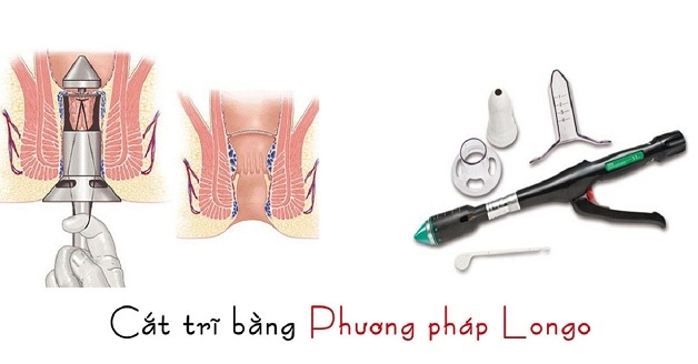 Trả lời phẫu thuật cắt trĩ giá bao nhiêu