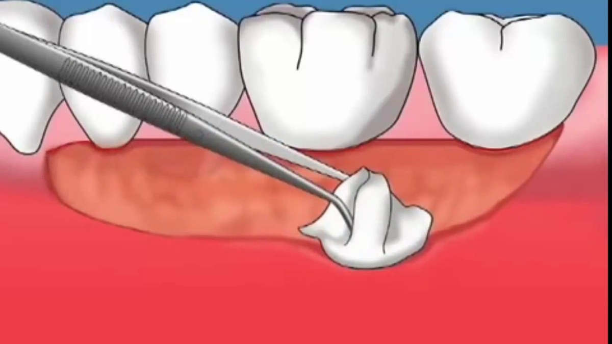 Phẫu thuật ghép lợi và những điều cần biết 