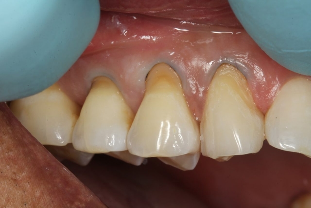 Phục hồi cổ răng bằng Composite &#8211; có phải ai cũng có thể thực hiện?
