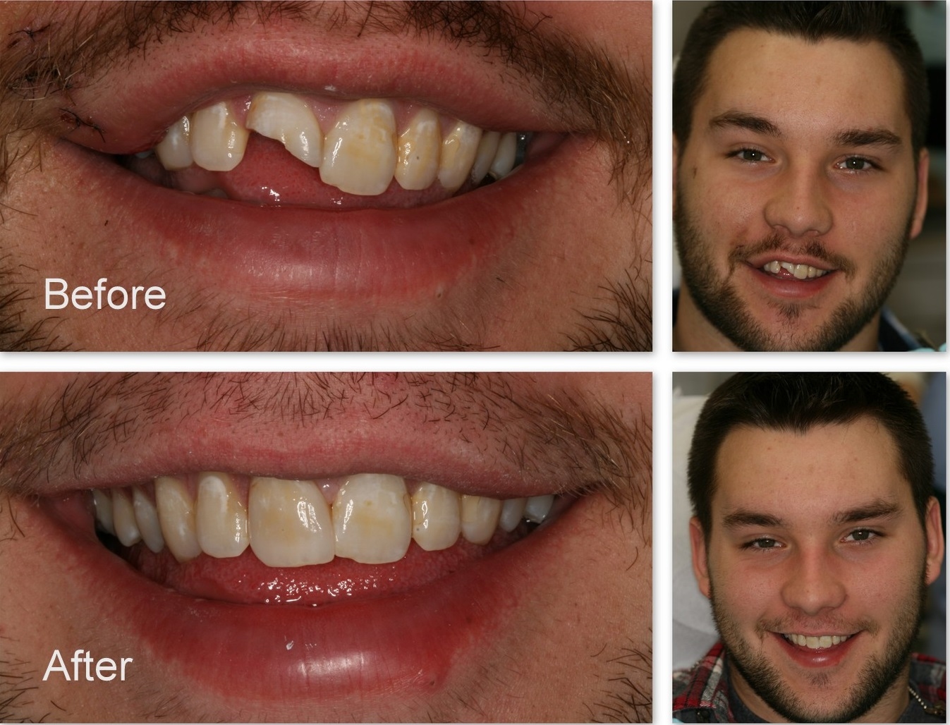 Trước và sau bọc sứ cho răng bể lớn