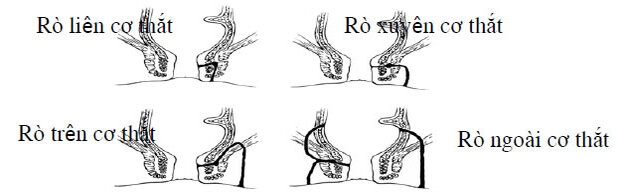 Phân loại các dạng rò hậu môn