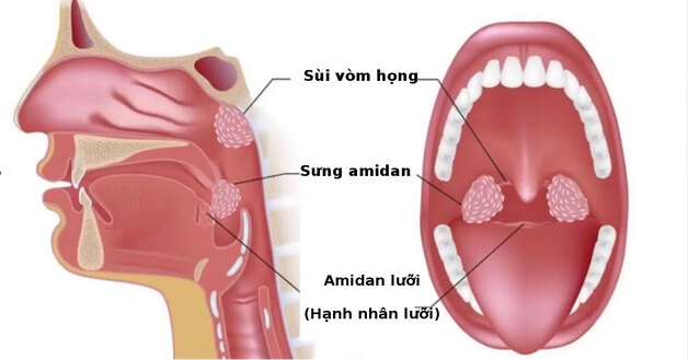 sưng amidan nên làm gì