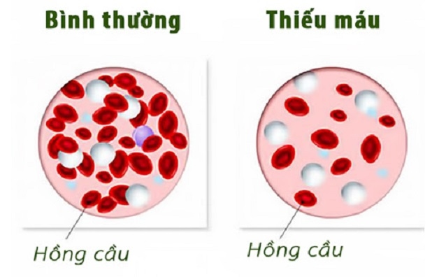 Thiếu máu não ở trẻ em là tình trạng không đủ tế bào hồng cầu để vận chuyển oxy cung cấp đi nuôi các cơ quan trong cơ thể trong đó có não bộ.