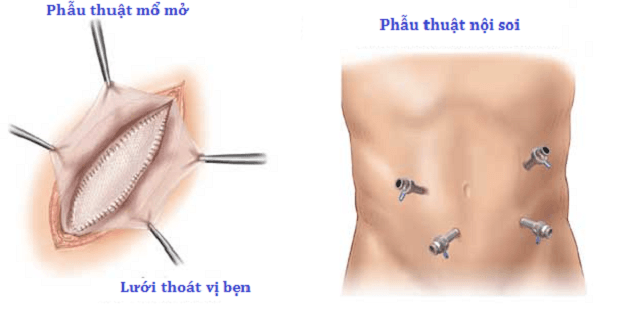Thoát vị bẹn có thể để lại những biến chứng nguy hiểm nếu không được điều trị kịp thời