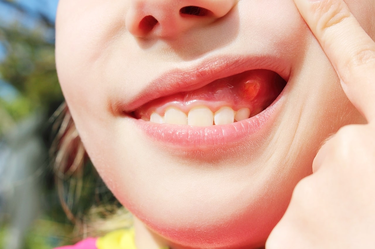Trẻ bị nổi cục ở lợi, nguyên nhân do đâu và làm sao để điều trị?