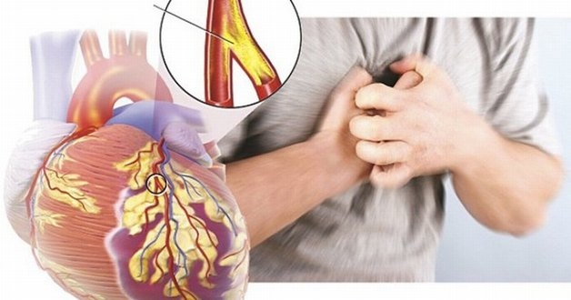 triệu chứng của tắc nghẽn động mạch vành 