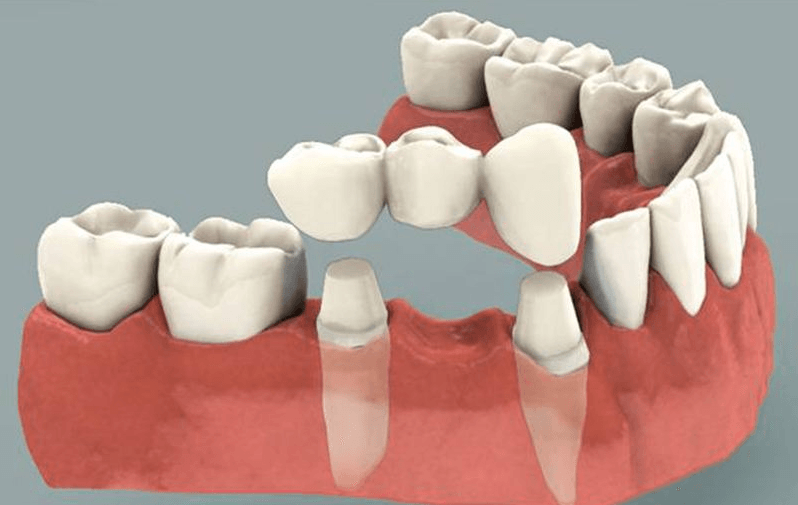 Mô phỏng phương pháp phục hình răng cố định