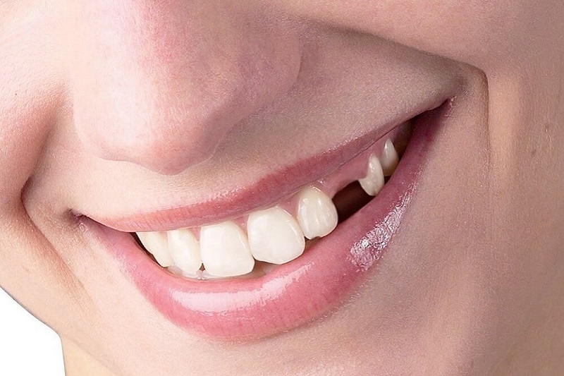 Trồng răng giả là phương pháp hiệu quả nhất cho người mất răng
