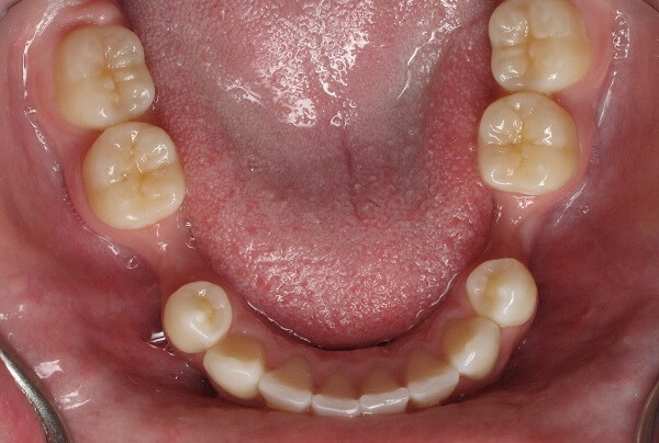 Sử dụng phương pháp phục hình tháo lắp vẫn bị tiêu xương hàm