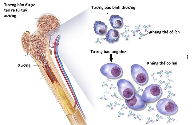 ung thư tủy có chữa được không