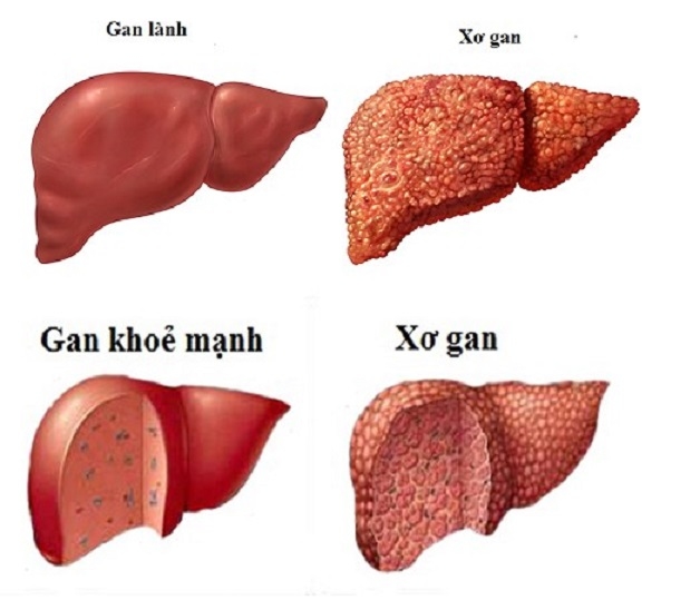 Xơ gan cổ trướng là gì? Là khi các tế bào gan trở thành các mô xơ.