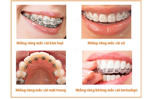 Các phương pháp nẹp răng hô phổ biến hiện nay 