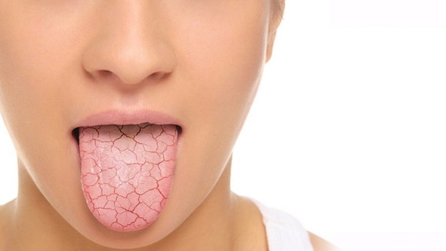 Tìm hiểu ngay: Cần làm gì nếu niêm mạc miệng bị khô?