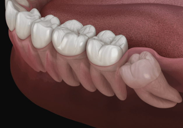 Nếu không điều trị kịp thời, răng khôn có thể gây ra nhiều ảnh hưởng cho người bệnh