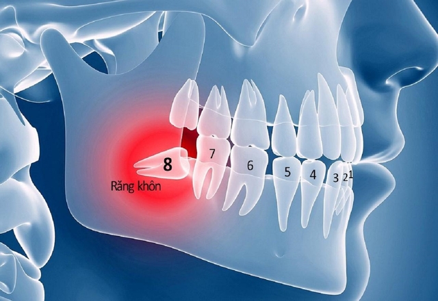 Răng khôn mọc ngầm trong xương: tác hại và cách chữa trị 