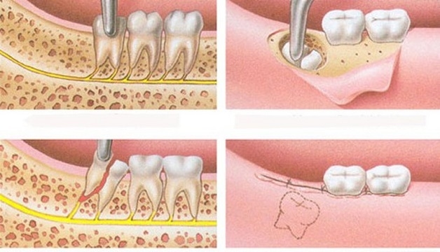 Quy trình nhổ răng khôn mọc ngầm