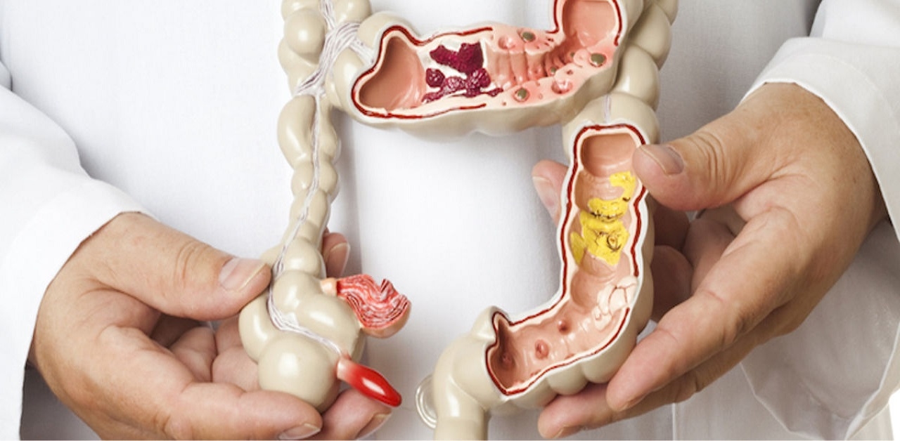 Phân biệt sa trực tràng và trĩ &#8211; Đâu là cách điều trị hiệu quả?