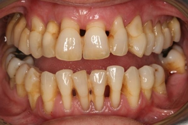 Do lợi bị tụt nên giữa các răng hình thành khoảng cách