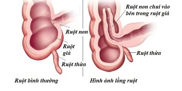 Bệnh lồng ruột là hiện tượng một đoạn ruột bị chui vào bên trong lòng một đoạn ruột ngay kế cận gây tắc nghẽn máu và dịch tiêu hóa