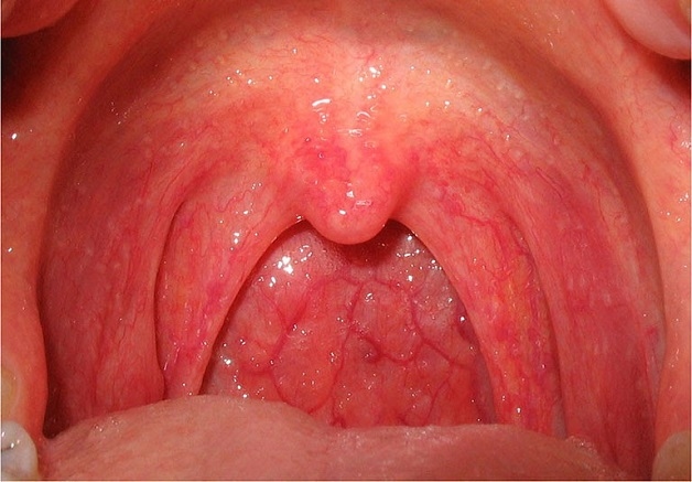 viêm họng uống thuốc gì để nhanh khỏi