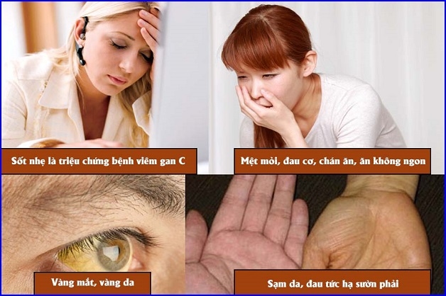 Khi ở giai đoạn mãn tính các triệu chứng viêm gan C ngày càng rõ rệt