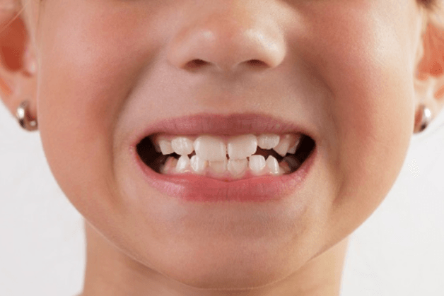 Tuy hiếm gặp nhưng thói quen nghiến răng cũng góp phần khiuến men răng tổn thương, gây đau răng ở trẻ.