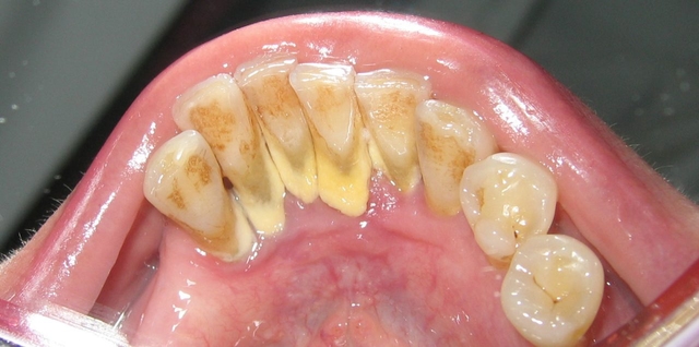 Cao răng nhiều phải làm sao để điều trị?