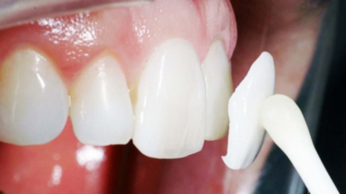 Dán Veneer răng &#8211; &#8220;Mặt nạ&#8221; hoàn hảo cho hàm răng khuyết điểm