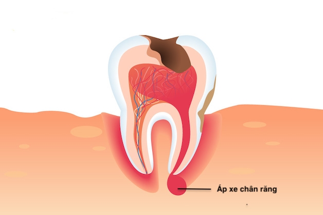 - Viêm tủy răng khôn nhanh chóng dẫn đến viêm lợi và áp xe chân răng.