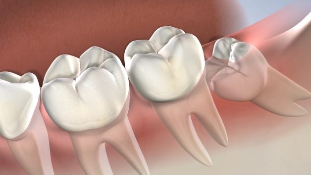 Một người bình thường sẽ có khoảng 32 răng trong đó có 4 răng khôn