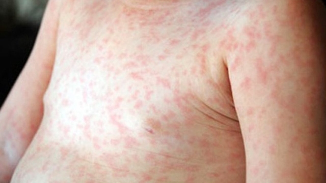 Trẻ 4 tháng bị nổi mẩn đỏ có nguy hiểm không?