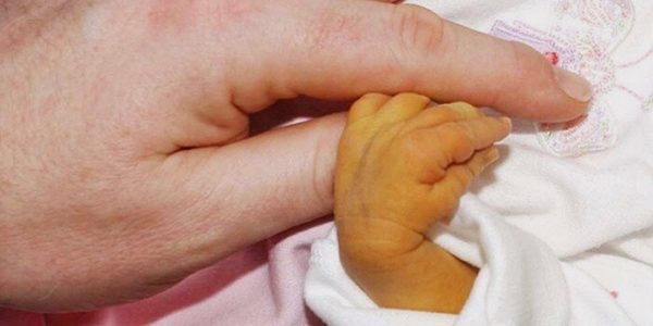 Trẻ sơ sinh bị vàng da vàng mắt 