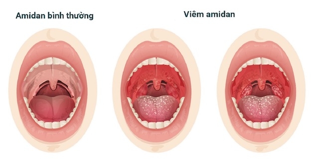 Triệu chứng điển hình của viêm nhiễm amidan ở trẻ chính là sưng và tấy đỏ.