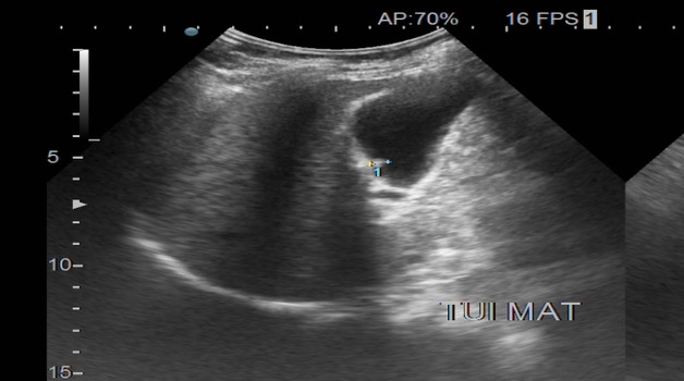 Chẩn đoán túi mật có polyp bằng siêu âm