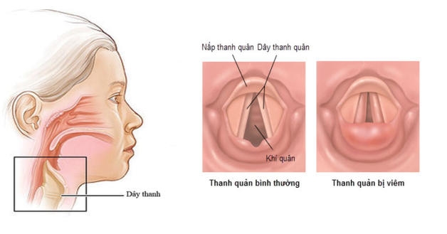 hình ảnh viêm thanh quản
