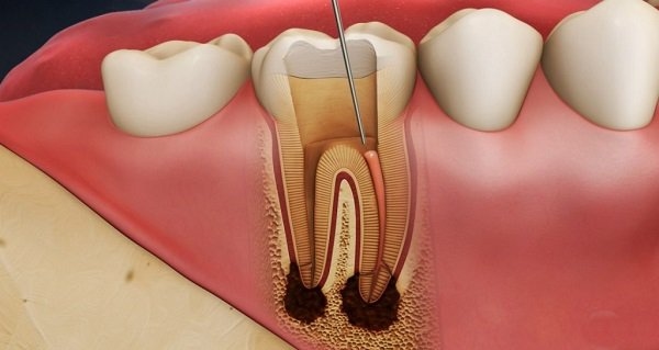 răng cấm lung lay có nên nhổ