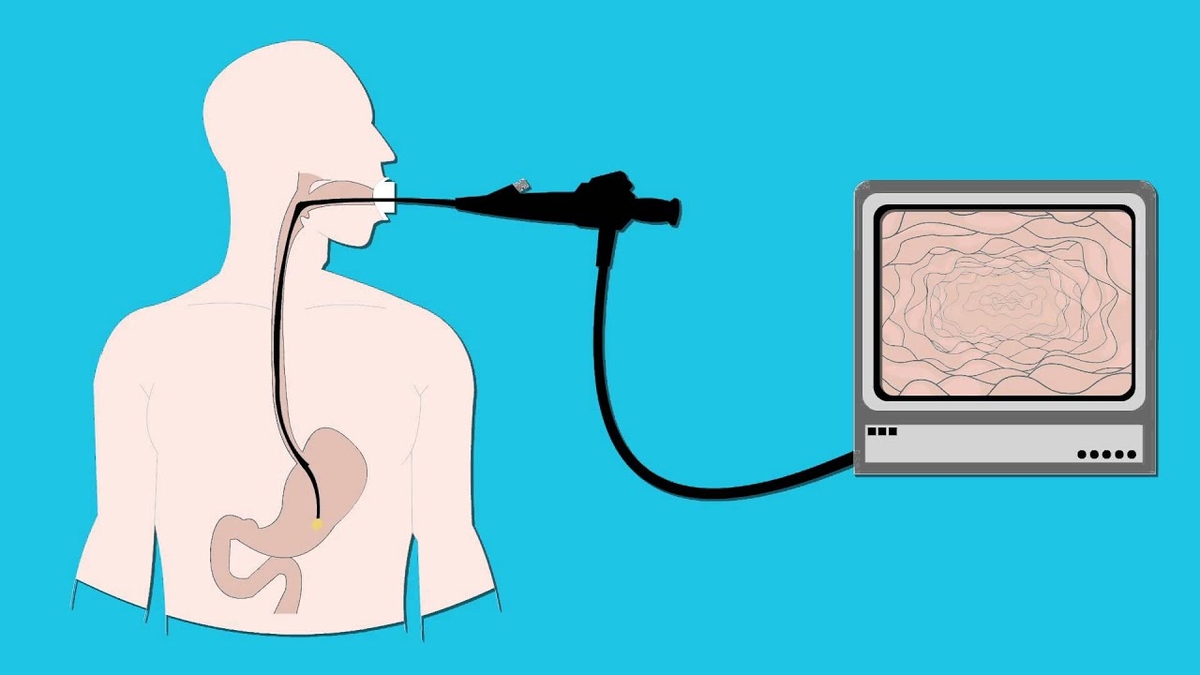 Bảng giá nội soi dạ dày và những lưu ý khi thực hiện