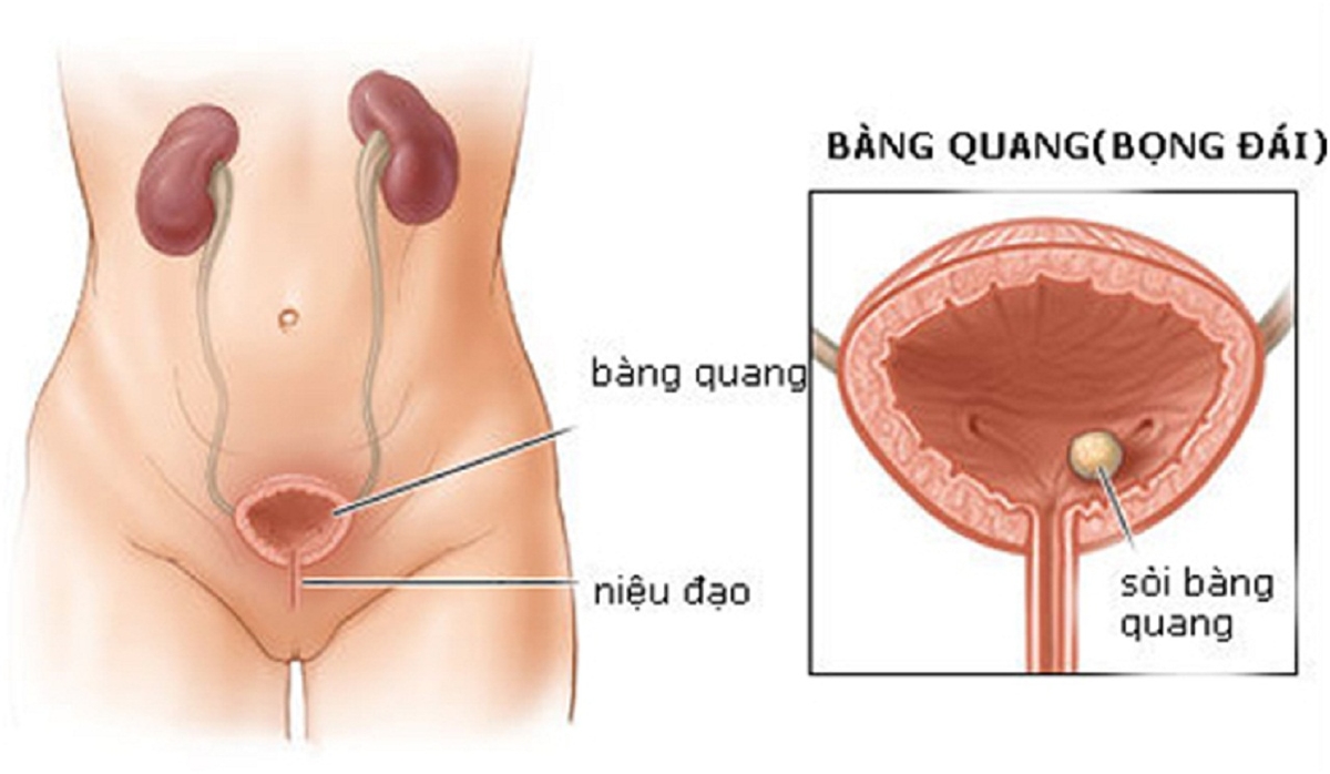 Bị sỏi bàng quang nên ăn gì và không nên ăn gì &#8211; Giải đáp