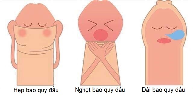 Minh họa các tình trạng bất thường bao quy đầu có thể gặp 