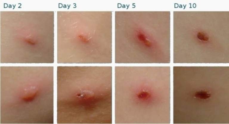 Quá trình phát triển và thoái triển của mụn thủy đậu