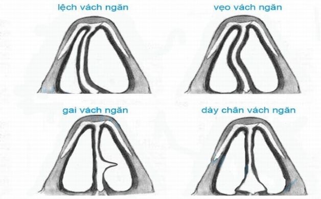 Khi vách ngăn mũi bị cong vẹo, lệch sang một bên, khiến hai khoang mũi không bằng nhau, một bên lớn hơn, một bên nhỏ.