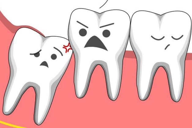 Răng khôn số 8 nói chung và răng khôn số 8 mọc lệch nói riêng, đều gây ra các triệu chứng khó chịu.