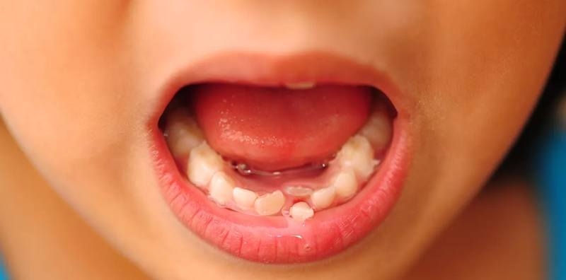 Răng vĩnh cửu đã mọc mà răng sữa chưa rụng gây ra tình trạng mọc lệch