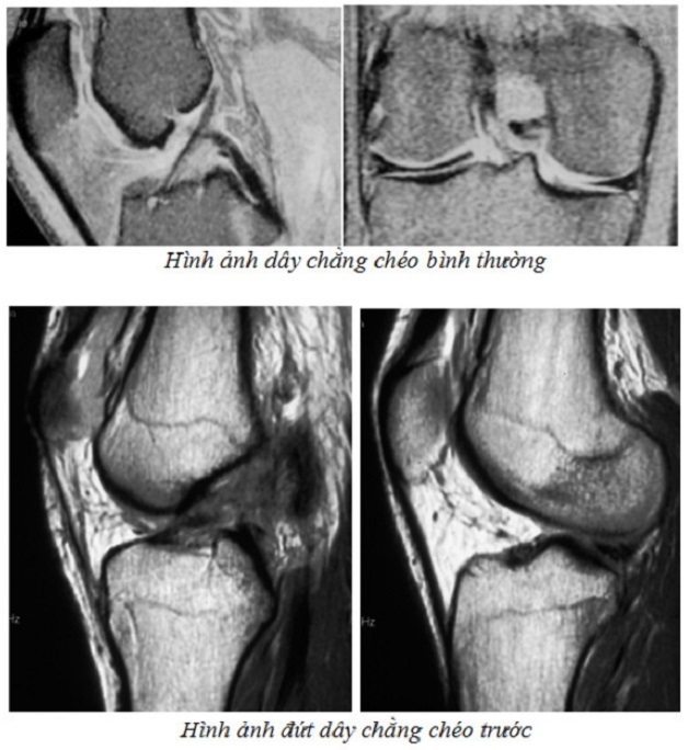 hụp mri khớp gối ở đâu phát hiện được đứt dây chằng chéo