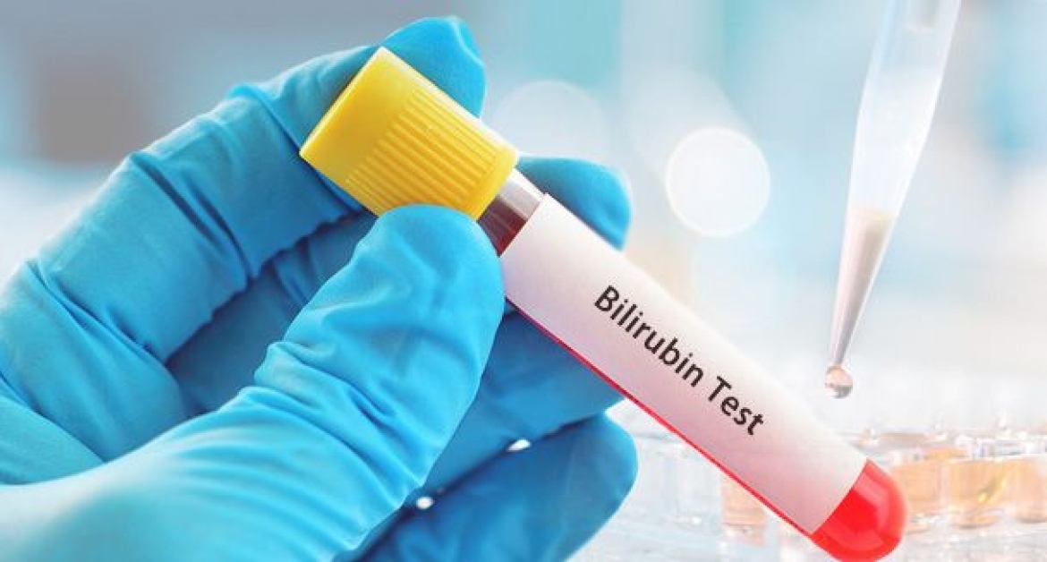 Muốn biết trẻ sơ sinh bị vàng da có sao không cần thực hiện xét nghiệm kiểm tra nồng độ Bilirubin trong máu