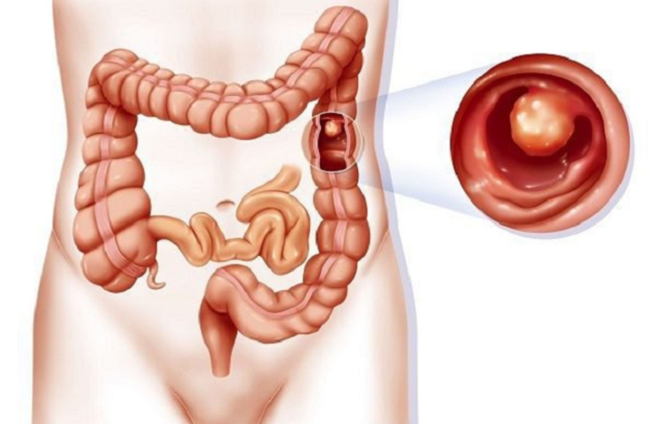 U đại tràng lành tính &#8211; ác tính: phân biệt và điều trị 