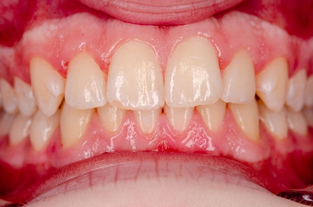 Dấu hiệu viêm nha chu cảnh báo vấn đề răng miệng