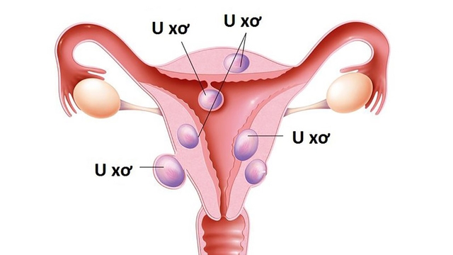 Đa nhân xơ tử cung loại 4 là gì? Có điều trị được không?